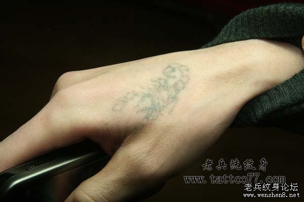 手部蝎子激光洗纹身案例