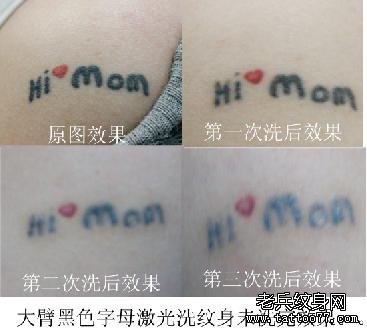 专业激光洗纹身在皮肤上的疼痛感