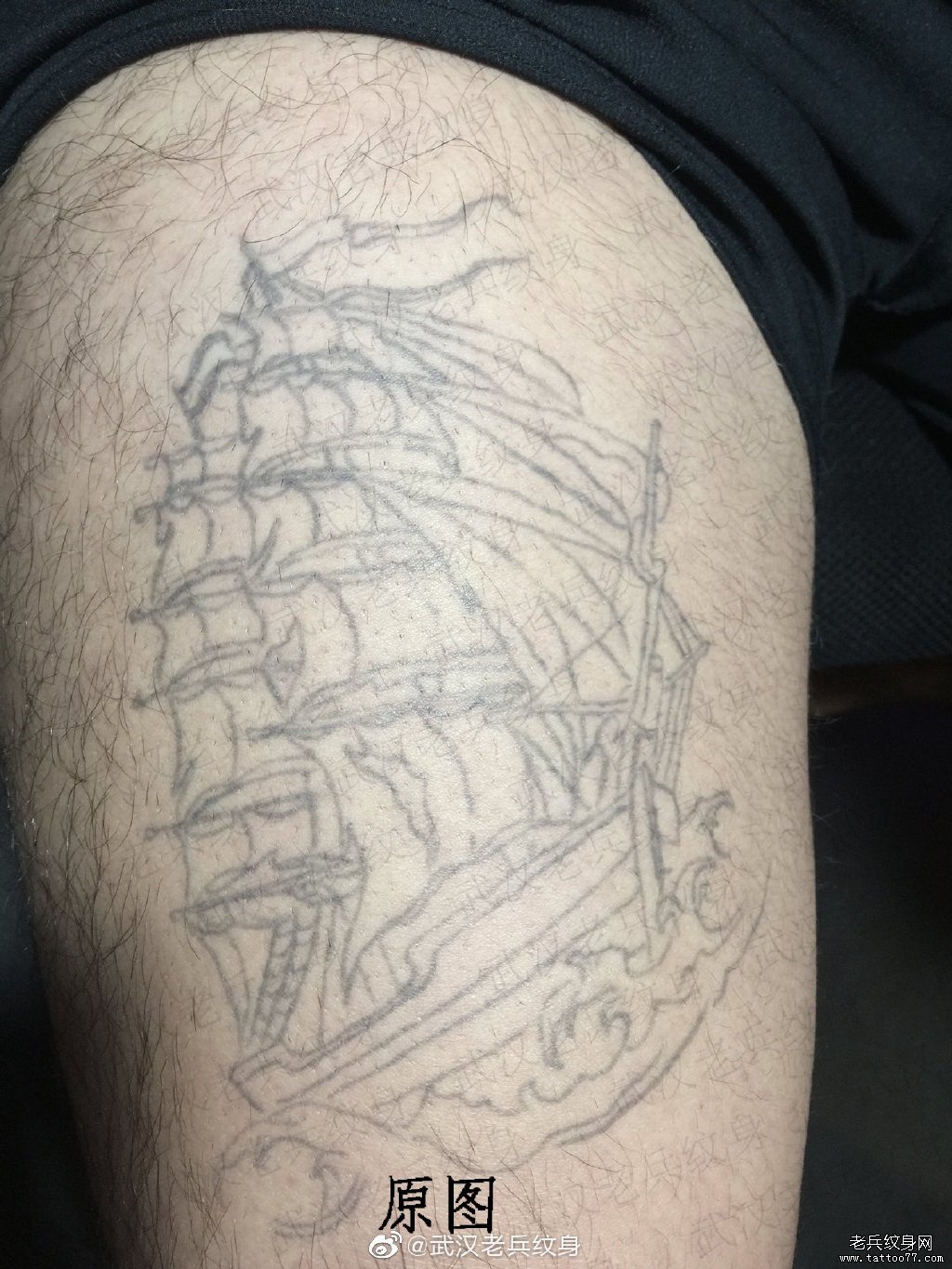 大腿帆船皮秒洗纹身过程