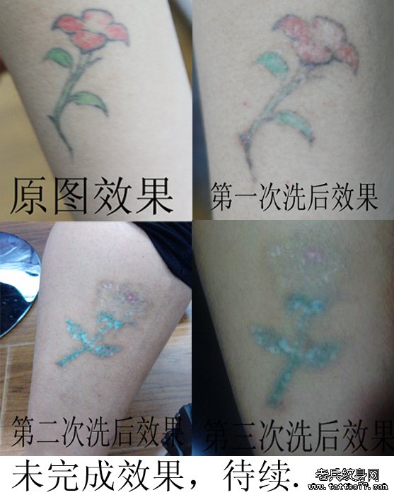 手部红色绿色激光洗纹身效果案例