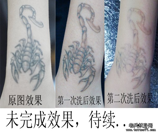 武汉最专业洗纹身店介绍手部蝎子黑色激光洗纹身效果
