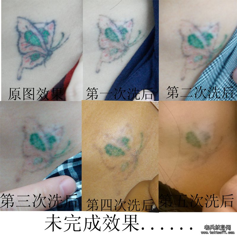 武汉最好的彩色激光洗纹身店带来最好的彩色洗纹身案例