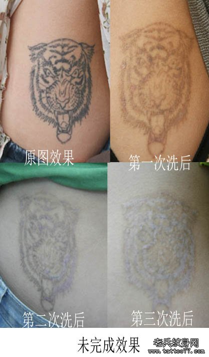 腰部黑色激光洗纹身过程及次次数