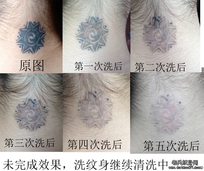 最专业激光洗纹身店黑色纹身图案激光洗过五次后的效果