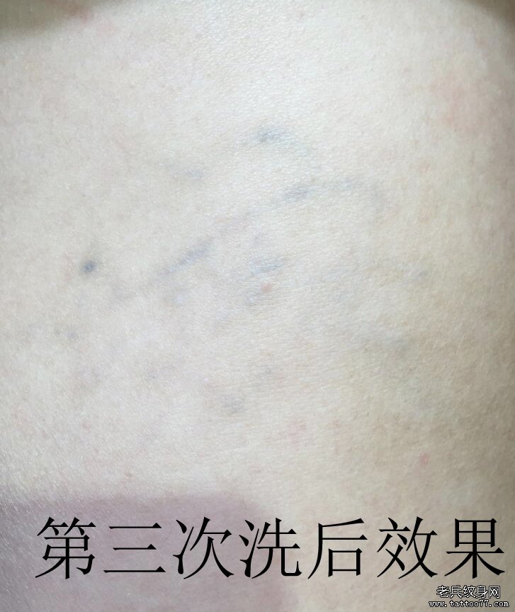 武汉最好的激光洗纹身店黑色洗纹身过程